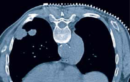 Interventional Radiology SeeGrid® Guiding Device
